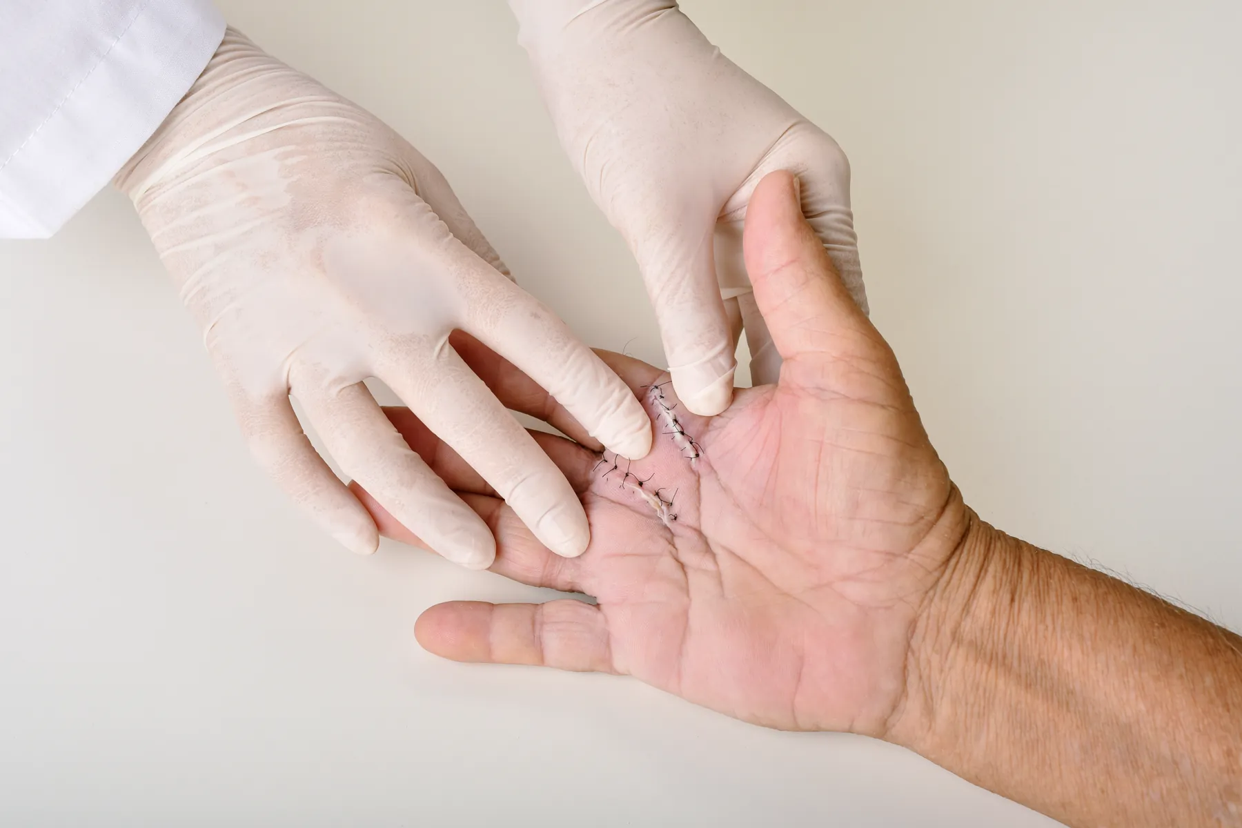 Sterilno previjanje postoperativne rane
